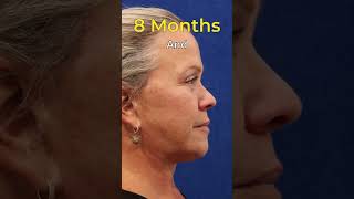 Facelift  Neck Lift  Blepharoplasty  Stunning Results [upl. by Hecker]