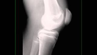 Fracture of Patella on X ray [upl. by Anivahs299]