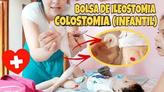 BOLSA DE COLOSTOMIA  ILEOSTOMIA INFANTIL passo a passo [upl. by Donni]