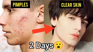 How to Get clear skin😍 just in 2 days😮 [upl. by Poliard842]