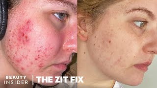 My 8Month Accutane Journey Side Effects And Results  The Zit Fix [upl. by Shotton]