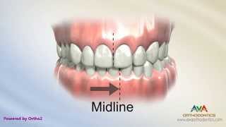 Orthodontic Treatment for Narrow Upper Jaw with Functional Shift  Expander or Spacer [upl. by Eaver511]