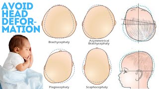 how to prevent flat head syndrome in infants [upl. by Thessa]