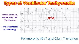 Types of Ventricular Tachycardia [upl. by Good219]