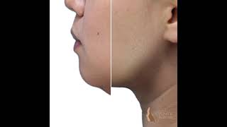 Kybella Injection [upl. by Aicilf]