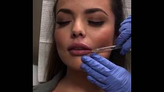 Juvederm Ultra Lip Injections  La Jolla Cosmetic Laser Clinic [upl. by Philo387]