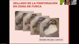 Tema quotAccidentes y complicaciones en Endodonciaquot [upl. by Eemaj]