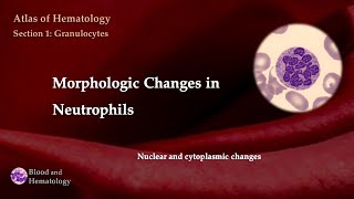 Morphologic Changes in Neutrophils nuclear and cytoplasmic changes [upl. by Anwahsal]