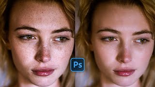 HOW TO FADE FRECKLES Dr Dray [upl. by Lorinda]