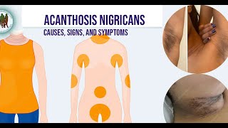 Acanthosis Nigricans Causes Signs and Symptoms [upl. by Mattias]