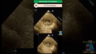 Intracardiac Thrombosis LV Atrial contrast [upl. by Conroy]