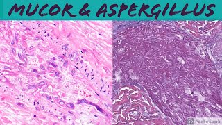 Mucormycosis amp Aspergillosis Angioinvasive Fungal Infection [upl. by Eicrad]