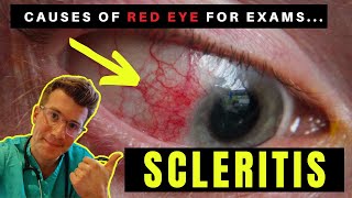 Causes of Red Eye  Part 3 SCLERITIS [upl. by Yrrab909]