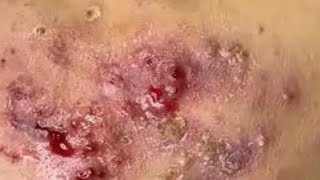 SEVERE CYSTIC ACNE Removal 😲 Crusty Scabs on Cheeks Hana Spa [upl. by Goodrow837]