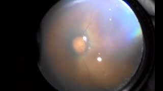 Indirect Ophthalmoscopes with Camera Neitz BSCAMERA and IOa LED CAMERA sample video [upl. by Chadwick]