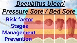 FON  Decubitus Ulcer Pressure Sore Bed Sore Pressure Ulcer NORCET AIIMS RRB nandanio4t [upl. by Nhepets]