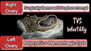 Left Polycystic Ovary PCOD  Hemorrhagic Cyst  Right Ovary Oophorectomy  TVS Infertility [upl. by Omlesna640]