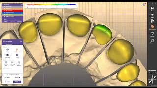 design reduced crown for metalo ceramic design exocad 32 elefsina 38 [upl. by Yendirb]