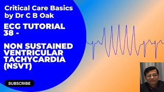 ECG Tutorial 38 Non sustained Ventricular Tachycardia [upl. by Beisel]