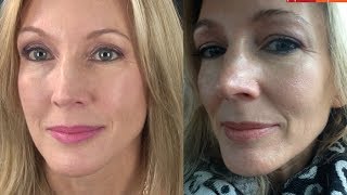 My Experience With Botox amp Filler Juvederm [upl. by Deirdra]