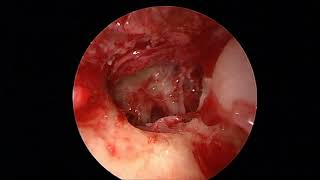 Endoscopic Transcanal Excision of Otic Capsule Schwannoma [upl. by Eiramannod]