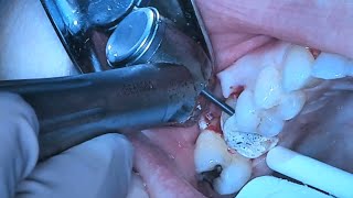 Upper molar Surgical Extraction [upl. by Clint]