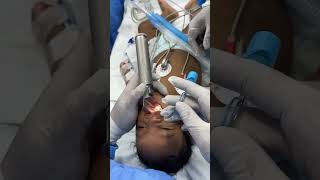 Intubating a cleft kid  Richardsons by our pediatric cardiac anesthesiologist and his team [upl. by Ariaet]