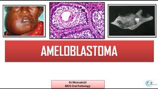 Ameloblastoma  Benign Odontogenic Tumor [upl. by Ikcaj]