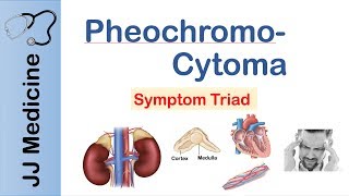 Pheochromocytoma  Symptoms and Treatment [upl. by Lorolla]