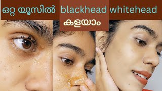 Blackheads  Whiteheads കളയുന്നത് നോക്ക് permanently remove blackheads amp whiteheads 👍 [upl. by Anitnahs]