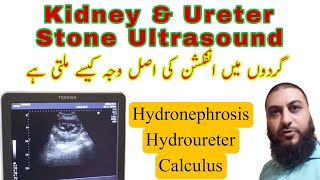 Kidney stone  ureter stone  Hydronephrosis  Hydroureter  Dr Qazi Fahim Shezad [upl. by Kironde]