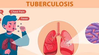 Tuberculosis Diagnosis and management 🫁🩺🩻💊⚕️marrowmeddamsdelhidbmciofficialPrepLaddermedpg [upl. by Hinkle]