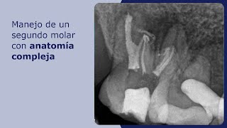 Manejo de un segundo molar con anatomía compleja [upl. by Tnerb]