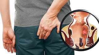 Natural Remedies for Hemorrhoids Effective Home Treatments and Tips for Fast Relief [upl. by Fraze]