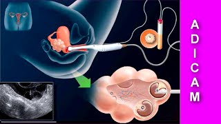 Herencia y Cáncer de Mama Aspectos reproductivos [upl. by Ybrek]