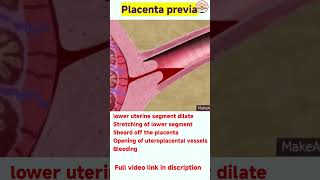 Placenta previa kya hai  what is placenta previa shorts [upl. by Baskett]