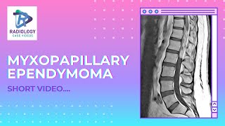 Myxopapillary Ependymoma Umamaheshwar Reddy V [upl. by Aikcin217]