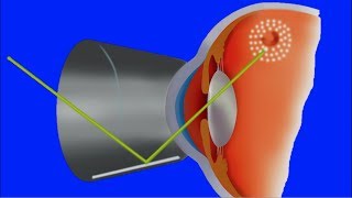 Agujeros y Desgarros de la retina Cuerpos flotantes moscas y luces Clínica Bonafonte [upl. by Ursulette]