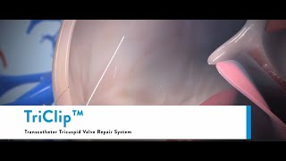 Triclip Transcatheter Tricuspid Valve Repair System  Tricuspid valve regurgitation [upl. by Scheers]