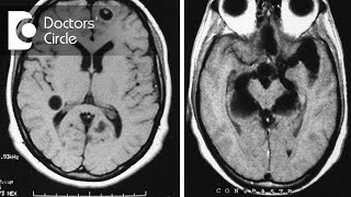 What do granuloma with Neurocysticercosis amp Tuberculoma in MRI brain signify  Dr Vykunta Raju K N [upl. by Nnylrahc574]