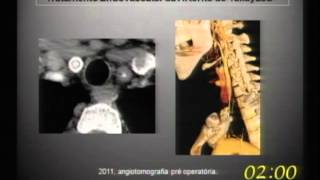 Resultados do tratamento endovascular na arterite de Takayasu [upl. by Nireil]