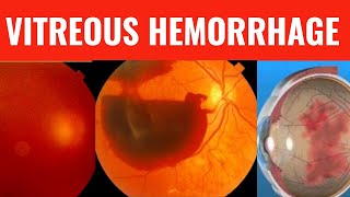 VITREOUS HEMORRHAGE  Everything you need to know [upl. by Heidy]