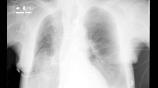 Pulmonary infiltrates in ICU [upl. by Ashia]