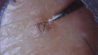 Long ingrown hair removal 23 [upl. by Junno]