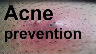 Acne prevention [upl. by Nnyleak]