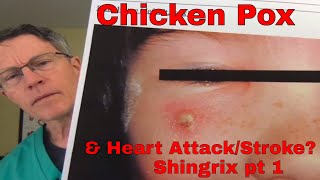 Shingrix part 1 A Childhood Virus Causing Heart Attack Stroke and Blindness  FORD BREWER MD MPH [upl. by Aika]