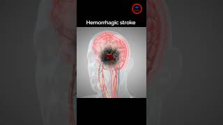 The goal of Treat Hemorrhagic stroke  stroke bleeding [upl. by Nyrroc]