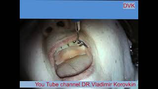 Infiltration Anesthesia for treatment 22 tooth [upl. by Lori]