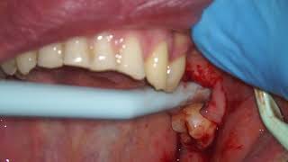 TOOTH ABSCESS PUS DRAINAGE THROUGH EXTRACTION SOCKET [upl. by Polly909]