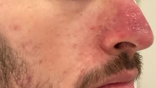 easy way to get rid of nose pimple bumps fast [upl. by Arol]